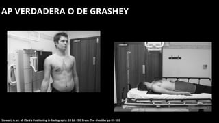 ANATOMIA RADIOLOGICA DEL HOMBRO CON EJEMPLOS | PPTX