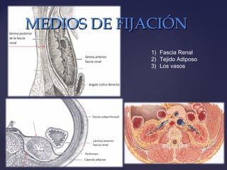 1) Fascia Renal
2) Tejido Adiposo
3) Los vasos
MEDIOS DE FIJACIÓNMEDIOS DE FIJACIÓN
 