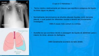 O que é O Hidrotórax ?
• Termo médico relativamente em desuso que significa a presença de líquido
no tórax (água na pleura).
• Normalmente denominamos as efusões pleurais líquidas como derrame
pleural, o qual poderá ter diferentes causas e deverá ser prontamente
investigado.
OBS:A causa mais comum é a cirrose.
• Acredita-se que acontece devido à passagem de líquido do abdômen para o
interior do tórax, através do diafragma.
OBS:Geralmente acontece do lado direito.
 