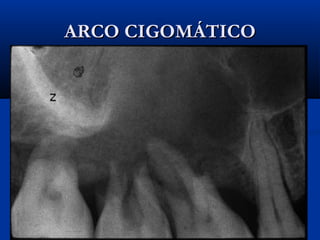 ARCO CIGOMÁTICOARCO CIGOMÁTICO
 