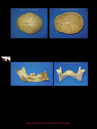 2222
Anatomia do sistema locomotor e atlas fotográfico do sistema esquelético
1 - Frontal
2 - Occipital
3 - Parietal
4 - Sutura lambdoide
5 - Sutura sagital
6 - Sutura coronal
7 - Bregma
12 - Vértice
4 - Sutura lambdoide
8 - Fovéolas granulares
(para as granulações aracnoideas)
9 - Sulco causado pelos ramos da artéria meníngea
média
10 - Sulco do seio sagital superior
11 - Crista frontal
1 - Cabeça da mandíbula
2 - Colo da mandíbula
3 - Processo coronoide
9 - Incisura da mandíbula
10 - Língula da mandíbula
11 - Forame da mandíbula
12 - Crista temporal
13 - Tuberosidade pterigoidea
14 - Linha milo-hioidea
15 - Fóvea submandibular
16 - Fóvea sublingual
17 - Espinhas mentonianas
18 - Fossa digástrica
19 - Sulco milo-hioideo
1 - Cabeça da mandíbula
2 - Colo da mandíbula
3 - Processo coronoide
10 - Língula da mandíbula
11 - Forame da mandíbula
12 - Crista temporal
13 - Tuberosidade terigoidea
14 - Linha milo-hioidea
15 - Fóvea submandibular
16 - Fóvea sublingual
17 - Espinhas mentonianas
20 - Ângulo da mandíbula
 