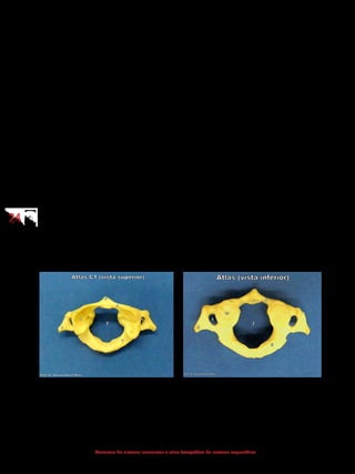 2424
Anatomia do sistema locomotor e atlas fotográfico do sistema esquelético
4.2.1 Elementos descritivos de uma vértebra típica
Corpo vertebral: estrutura óssea projetada anteriormente, a qual apre-
senta o maior volume ósseo de uma vértebra e transfere o peso do corpo ao longo
da coluna vertebral.
Forame vertebral: local por onde passa a medula espinhal.
Arco vertebral: estrutura óssea que forma os limites laterais e posterior
do forame vertebral.
Processo espinhoso: estrutura óssea mediana, que se projeta posterior-
mente, partindo do arco vertebral.
Processo transverso: estrutura óssea, que se projeta lateralmente, par-
tindo do arco vertebral.
Processos articulares superiores e inferiores: estruturas ósseas, que
se projetam superior e inferiormente, partindo do arco vertebral. Servem de pon-
to de fixação com as vértebras adjacentes.
4.2.2 Vértebras cervicais
Apresentam forame no processo transverso para a passagem da artéria
vertebral. O processo espinhoso pode ser bifurcado. A primeira vértebra cervical
(C1 ou atlas) e a segunda vértebra cervical (C2 ou áxis) apresentam caracterís-
ticas próprias:
- 	atlas: não possui corpo vertebral e processo espinhoso;
- 	áxis: a sua principal característica é a presença de um dente (processo
odontoide).
1 - Forame do processo transverso
2 - Forame vertebral
4 - Processo transverso
6 - Tubérculo anterior
7 - Face articular superior
8 - Arco anterior
9 - Arco posterior
1 - Forame do processo transverso
2 - Forame vertebral
4 - Processo transverso
8 - Arco anterior
9 - Arco posterior
14 - Face articular (para o dente áxis)
15 - Face articular superior (para o côndilo do
occipital)
 