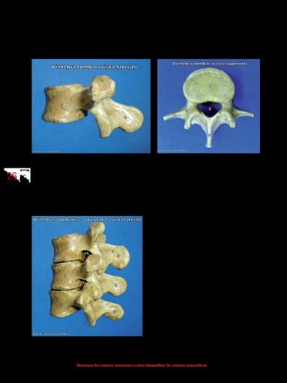 2626
Anatomia do sistema locomotor e atlas fotográfico do sistema esquelético
4.2.4 Vértebras lombares
As vértebras lombares, as maiores da coluna, têm o corpo vertebral grande
e forte, apresentando o processo espinhoso curto com um formato quadrangular.
3 - Corpo vertebral
4 - Processo transverso
5 - Processo espinhoso
13 - Processo articular superior
17 - Processo articular inferior
2 - Forame vertebral
3 - Corpo vertebral
4 - Processo transverso
5 - Processo espinhoso
11 - Pedículo do arco vertebral
12 - Lâmina do arco vertebral
13- Processo articular superior
3 - Corpo
4 - Processo transverso
5 - Processo espinhoso
17 - Processo articular inferior
19 - Forame intervertebral
Obs.: As vértebras situadas em locais de transição entre as regiões da coluna vertebral podem
apresentar as características das vértebras adjacentes.
 