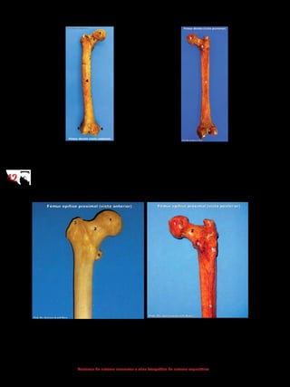 4242
Anatomia do sistema locomotor e atlas fotográfico do sistema esquelético
1 - Cabeça
2 - Colo
3 - Trocanter maior
4 - Diáfise
5 - Epicôndilo lateral
6 - Epicôndilo medial
7 - Face patelar
1 - Cabeça
2 - Colo
3 - Trocanter maior
8 - Trocanter menor
9 - Linha áspera
10 - Fossa intercondilar
11 - Côndilo medial
12 - Côndilo lateral
1 - Cabeça
2 - Colo
3 - Trocanter maior
8 - Trocanter menor
1 - Cabeça
2 - Colo
3 - Trocanter maior
8 - Trocanter menor
9 - Linha áspera
 
