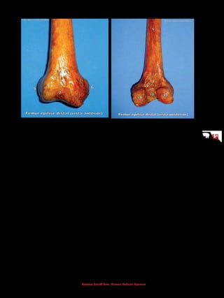 4343
Gustavo Graeff Kura, Marcos Roberto Spassim
5 - Epicôndilo lateral
6 - Epicôndilo medial
7 - Face patelar
9 - Linha áspera
10 - Fossa intercondilar
11 - Côndilo medial
12 - Côndilo lateral
5.2.3 Patela
Localizada entre o fêmur e a tíbia, na articulação do joelho, posiciona-se no
interior do tendão do músculo quadríceps femoral, tendo como principal função
melhorar a ação de alavanca desse músculo. É o maior osso sesamoide do corpo,
de formato triangular.
 
