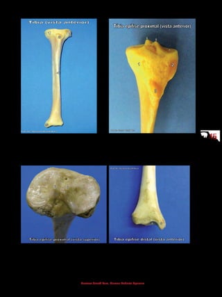 4545
Gustavo Graeff Kura, Marcos Roberto Spassim
3 - Tuberosidade da tíbia
4 - Margem anterior da tíbia
5 - Maléolo medial
1 - Côndilo medial
2 - Côndilo lateral
3 - Tuberosidade da tíbia
6 - Tubérculo intercondilar (eminência)
7 - Face articular superior
6 - Tubérculo intercondilar (eminência)
7 - Face articular superior
5 - Maléolo medial
8 - Face articular inferior
 