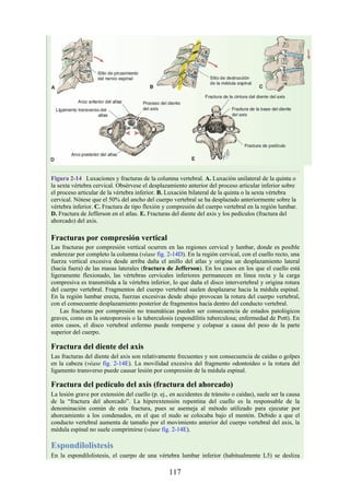 Figura 2-14 Luxaciones y fracturas de la columna vertebral. A. Luxación unilateral de la quinta o
la sexta vértebra cervical. Obsérvese el desplazamiento anterior del proceso articular inferior sobre
el proceso articular de la vértebra inferior. B. Luxación bilateral de la quinta o la sexta vértebra
cervical. Nótese que el 50% del ancho del cuerpo vertebral se ha desplazado anteriormente sobre la
vértebra inferior. C. Fractura de tipo flexión y compresión del cuerpo vertebral en la región lumbar.
D. Fractura de Jefferson en el atlas. E. Fracturas del diente del axis y los pedículos (fractura del
ahorcado) del axis.
Fracturas por compresión vertical
Las fracturas por compresión vertical ocurren en las regiones cervical y lumbar, donde es posible
enderezar por completo la columna (véase fig. 2-14D). En la región cervical, con el cuello recto, una
fuerza vertical excesiva desde arriba daña el anillo del atlas y origina un desplazamiento lateral
(hacia fuera) de las masas laterales (fractura de Jefferson). En los casos en los que el cuello está
ligeramente flexionado, las vértebras cervicales inferiores permanecen en línea recta y la carga
compresiva es transmitida a la vértebra inferior, lo que daña el disco intervertebral y origina rotura
del cuerpo vertebral. Fragmentos del cuerpo vertebral suelen desplazarse hacia la médula espinal.
En la región lumbar erecta, fuerzas excesivas desde abajo provocan la rotura del cuerpo vertebral,
con el consecuente desplazamiento posterior de fragmentos hacia dentro del conducto vertebral.
Las fracturas por compresión no traumáticas pueden ser consecuencia de estados patológicos
graves, como en la osteoporosis o la tuberculosis (espondilitis tuberculosa; enfermedad de Pott). En
estos casos, el disco vertebral enfermo puede romperse y colapsar a causa del peso de la parte
superior del cuerpo.
Fractura del diente del axis
Las fracturas del diente del axis son relativamente frecuentes y son consecuencia de caídas o golpes
en la cabeza (véase fig. 2-14E). La movilidad excesiva del fragmento odontoideo o la rotura del
ligamento transverso puede causar lesión por compresión de la médula espinal.
Fractura del pedículo del axis (fractura del ahorcado)
La lesión grave por extensión del cuello (p. ej., en accidentes de tránsito o caídas), suele ser la causa
de la “fractura del ahorcado”. La hiperextensión repentina del cuello es la responsable de la
denominación común de esta fractura, pues se asemeja al método utilizado para ejecutar por
ahorcamiento a los condenados, en el que el nudo se colocaba bajo el mentón. Debido a que el
conducto vertebral aumenta de tamaño por el movimiento anterior del cuerpo vertebral del axis, la
médula espinal no suele comprimirse (véase fig. 2-14E).
Espondilolistesis
En la espondilolistesis, el cuerpo de una vértebra lumbar inferior (habitualmente L5) se desliza
117
 