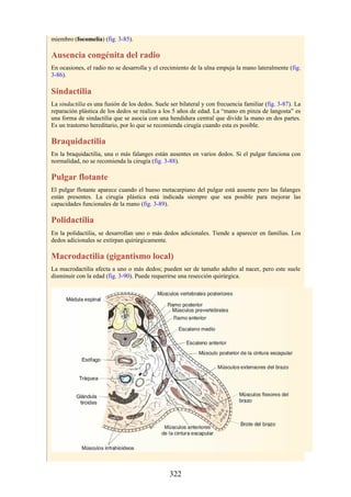 miembro (focomelia) (fig. 3-85).
Ausencia congénita del radio
En ocasiones, el radio no se desarrolla y el crecimiento de la ulna empuja la mano lateralmente (fig.
3-86).
Sindactilia
La sindactilia es una fusión de los dedos. Suele ser bilateral y con frecuencia familiar (fig. 3-87). La
reparación plástica de los dedos se realiza a los 5 años de edad. La “mano en pinza de langosta” es
una forma de sindactilia que se asocia con una hendidura central que divide la mano en dos partes.
Es un trastorno hereditario, por lo que se recomienda cirugía cuando esta es posible.
Braquidactilia
En la braquidactilia, una o más falanges están ausentes en varios dedos. Si el pulgar funciona con
normalidad, no se recomienda la cirugía (fig. 3-88).
Pulgar flotante
El pulgar flotante aparece cuando el hueso metacarpiano del pulgar está ausente pero las falanges
están presentes. La cirugía plástica está indicada siempre que sea posible para mejorar las
capacidades funcionales de la mano (fig. 3-89).
Polidactilia
En la polidactilia, se desarrollan uno o más dedos adicionales. Tiende a aparecer en familias. Los
dedos adicionales se extirpan quirúrgicamente.
Macrodactilia (gigantismo local)
La macrodactilia afecta a uno o más dedos; pueden ser de tamaño adulto al nacer, pero este suele
disminuir con la edad (fig. 3-90). Puede requerirse una resección quirúrgica.
322
 