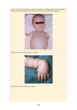 Figura 3-84 Sección a través de la región cervical inferior y la formación del esbozo del miembro
superior. Obsérvese la presencia de los huesos y músculos en desarrollo del mesénquima.
Figura 3-85 Ectromelia (cortesía de: G. Avery).
Figura 3-86 Ausencia congénita del radio.
323
 