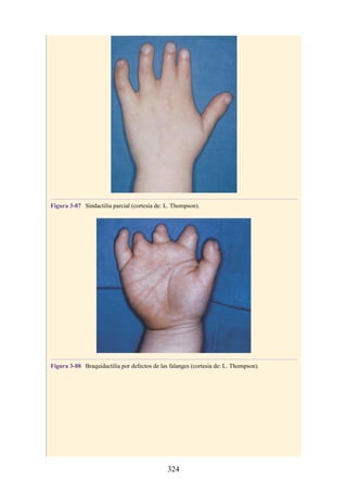 Figura 3-87 Sindactilia parcial (cortesía de: L. Thompson).
Figura 3-88 Braquidactilia por defectos de las falanges (cortesía de: L. Thompson).
324
 