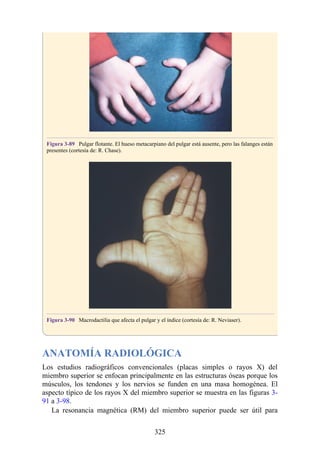 Figura 3-89 Pulgar flotante. El hueso metacarpiano del pulgar está ausente, pero las falanges están
presentes (cortesía de: R. Chase).
Figura 3-90 Macrodactilia que afecta el pulgar y el índice (cortesía de: R. Neviaser).
ANATOMÍA RADIOLÓGICA
Los estudios radiográficos convencionales (placas simples o rayos X) del
miembro superior se enfocan principalmente en las estructuras óseas porque los
músculos, los tendones y los nervios se funden en una masa homogénea. El
aspecto típico de los rayos X del miembro superior se muestra en las figuras 3-
91 a 3-98.
La resonancia magnética (RM) del miembro superior puede ser útil para
325
 