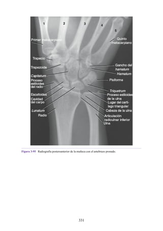 Figura 3-95 Radiografía posteroanterior de la muñeca con el antebrazo pronado.
331
 