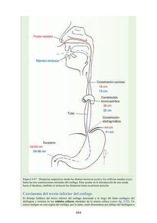 Figura 5-47 Distancias respectivas desde los dientes incisivos (azul) y los orificios nasales (rojo)
hasta las tres constricciones normales del esófago. Para ayudar en la introducción de una sonda
hacia el duodeno, también se incluyen las distancias hasta su primera porción.
Carcinoma del tercio inferior del esófago
El drenaje linfático del tercio inferior del esófago desciende a lo largo del hiato esofágico del
diafragma y termina en los nódulos celíacos alrededor de la arteria celíaca (véase fig. 5-22). Un
tumor maligno en esta región del esófago, por lo tanto, suele diseminarse por debajo del diafragma a
484
 