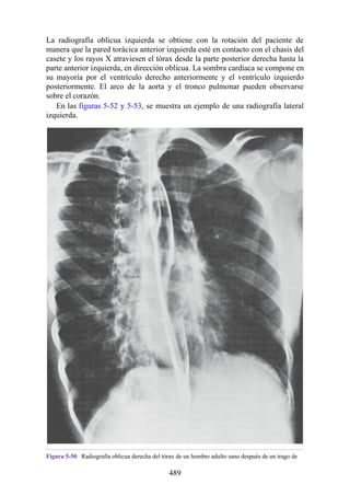 La radiografía oblicua izquierda se obtiene con la rotación del paciente de
manera que la pared torácica anterior izquierda esté en contacto con el chasis del
casete y los rayos X atraviesen el tórax desde la parte posterior derecha hasta la
parte anterior izquierda, en dirección oblicua. La sombra cardíaca se compone en
su mayoría por el ventrículo derecho anteriormente y el ventrículo izquierdo
posteriormente. El arco de la aorta y el tronco pulmonar pueden observarse
sobre el corazón.
En las figuras 5-52 y 5-53, se muestra un ejemplo de una radiografía lateral
izquierda.
Figura 5-50 Radiografía oblicua derecha del tórax de un hombre adulto sano después de un trago de
489
 