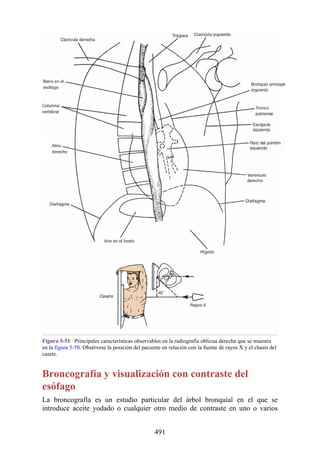 Figura 5-51 Principales características observables en la radiografía oblicua derecha que se muestra
en la figura 5-50. Obsérvese la posición del paciente en relación con la fuente de rayos X y el chasis del
casete.
Broncografía y visualización con contraste del
esófago
La broncografía es un estudio particular del árbol bronquial en el que se
introduce aceite yodado o cualquier otro medio de contraste en uno o varios
491
 