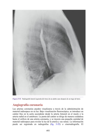 Figura 5-52 Radiografía lateral izquierda del tórax de un adulto sano después de un trago de bario.
Angiografía coronaria
Las arterias coronarias pueden visualizarse a través de la administración de
material radioopaco en su luz. Bajo visualización fluoroscópica, se introduce un
catéter fino en la aorta ascendente desde la arteria femoral en el muslo o la
arteria radial en el antebrazo. La punta del catéter se dirige de manera cuidadosa
hasta el orificio de una arteria coronaria, y se inyecta una pequeña cantidad de
material radioopaco para revelar la luz de la arteria y sus ramas. La información
puede ser registrada en radiografías (fig. 5-55) o cinerradiografía. El
493
 