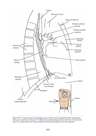 Figura 5-53 Características más importantes que se observan en la radiografía lateral izquierda del
tórax que se muestra en la figura 5-52. Obsérvese la posición del paciente en relación con la fuente de
rayos X y el chasis del casete. Nótese también la relación del esófago con el atrio izquierdo.
495
 