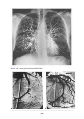 Figura 5-54 Broncograma posteroanterior del tórax.
496
 