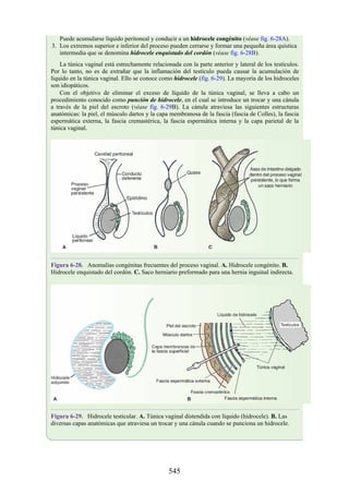 Puede acumularse líquido peritoneal y conducir a un hidrocele congénito (véase fig. 6-28A).
3. Los extremos superior e inferior del proceso pueden cerrarse y formar una pequeña área quística
intermedia que se denomina hidrocele enquistado del cordón (véase fig. 6-28B).
La túnica vaginal está estrechamente relacionada con la parte anterior y lateral de los testículos.
Por lo tanto, no es de extrañar que la inflamación del testículo pueda causar la acumulación de
líquido en la túnica vaginal. Ello se conoce como hidrocele (fig. 6-29). La mayoría de los hidroceles
son idiopáticos.
Con el objetivo de eliminar el exceso de líquido de la túnica vaginal, se lleva a cabo un
procedimiento conocido como punción de hidrocele, en el cual se introduce un trocar y una cánula
a través de la piel del escroto (véase fig. 6-29B). La cánula atraviesa las siguientes estructuras
anatómicas: la piel, el músculo dartos y la capa membranosa de la fascia (fascia de Colles), la fascia
espermática externa, la fascia cremastérica, la fascia espermática interna y la capa parietal de la
túnica vaginal.
Figura 6-28. Anomalías congénitas frecuentes del proceso vaginal. A. Hidrocele congénito. B.
Hidrocele enquistado del cordón. C. Saco herniario preformado para una hernia inguinal indirecta.
Figura 6-29. Hidrocele testicular. A. Túnica vaginal distendida con líquido (hidrocele). B. Las
diversas capas anatómicas que atraviesa un trocar y una cánula cuando se punciona un hidrocele.
545
 
