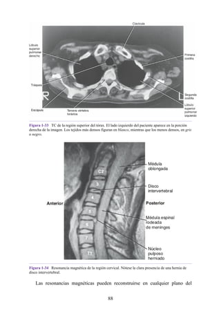 Figura 1-33 TC de la región superior del tórax. El lado izquierdo del paciente aparece en la porción
derecha de la imagen. Los tejidos más densos figuran en blanco, mientras que los menos densos, en gris
o negro.
Figura 1-34 Resonancia magnética de la región cervical. Nótese la clara presencia de una hernia de
disco intervertebral.
Las resonancias magnéticas pueden reconstruirse en cualquier plano del
88
 