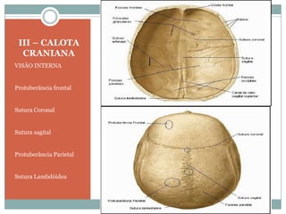 III – CALOTA
  CRANIANA
VISÃO INTERNA


Protuberância frontal


Sutura Coronal


Sutura sagital


Protuberância Parietal


Sutura Lambdóidea
 