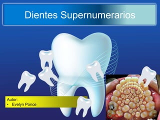 Dientes Supernumerarios
Autor:
• Evelyn Ponce
 