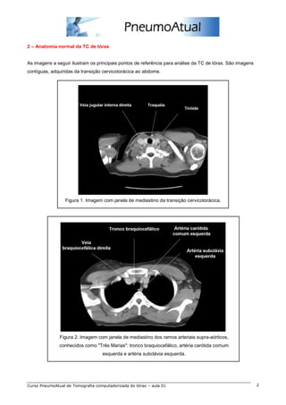 2 – Anatomia normal da TC de tórax


As imagens a seguir ilustram os principais pontos de referência para análise da TC de tórax. São imagens
contíguas, adquiridas da transição cervicotorácica ao abdome.




                  Figura 1. Imagem com janela de mediastino da transição cervicotorácica.




               Figura 2. Imagem com janela de mediastino dos ramos arteriais supra-aórticos,
               conhecidos como "Três Marias": tronco braquiocefálico, artéria carótida comum
                                   esquerda e artéria subclávia esquerda.




Curso PneumoAtual de Tomografia computadorizada do tórax – aula 01                                         2
 