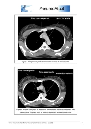 Figura 3. Imagem com janela de mediastino no nível do arco da aorta.




           Figura 4. Imagem com janela de mediastino demonstrando a aorta ascendente e aorta
                 descendente. O espaço entre as duas corresponde à janela aortopulmonar.




Curso PneumoAtual de Tomografia computadorizada do tórax – aula 01                             3
 