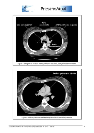 Figura 5. Imagem no nível da artéria pulmonar esquerda, com janela de mediastino.




                  Figura 6. Artéria pulmonar direita emergindo do tronco arterial pulmonar.




Curso PneumoAtual de Tomografia computadorizada do tórax – aula 01                              4
 