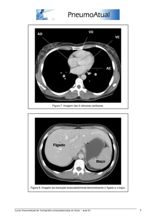 Figura 7. Imagem das 4 câmaras cardíacas.




             Figura 8. Imagem da transição toracoabdominal demonstrando o fígado e o baço.




Curso PneumoAtual de Tomografia computadorizada do tórax – aula 01                           5
 