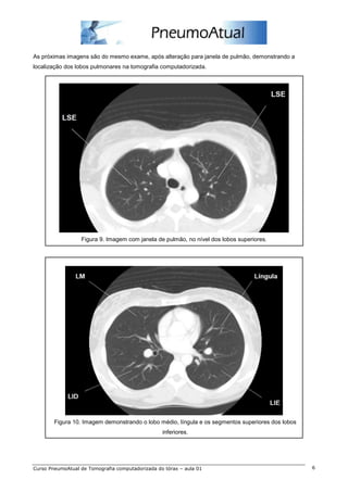 As próximas imagens são do mesmo exame, após alteração para janela de pulmão, demonstrando a
localização dos lobos pulmonares na tomografia computadorizada.




                  Figura 9. Imagem com janela de pulmão, no nível dos lobos superiores.




        Figura 10. Imagem demonstrando o lobo médio, língula e os segmentos superiores dos lobos
                                                  inferiores.




Curso PneumoAtual de Tomografia computadorizada do tórax – aula 01                                 6
 