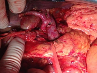 RETROPERITÔNIO
Pâncreas
Istmo
 