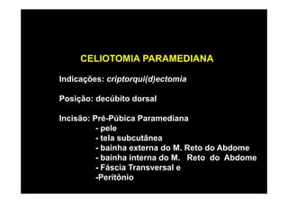 CELIOTOMIA PARAMEDIANA

Indicações: criptorqui(d)ectomia

Posição: decúbito dorsal

Incisão: Pré-Púbica Paramediana
          - pele
          - tela subcutânea
          - bainha externa do M. Reto do Abdome
          - bainha interna do M. Reto do Abdome
          - Fáscia Transversal e
          -Peritônio
 