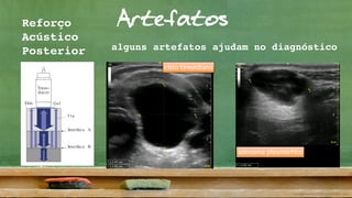 ArtefatosReforço
Acústico
Posterior
3
2
46
4538
70
45
51a
46
70
70
77
77
51b
ways return directly from the point of reflection to the trans-
ucer. The processor makes the same assumption when com-
uting the depth of the site of reflection. In reality, this is not
ways the case:
n their wayback to the transducer, the reflected sound waves
n encounter an impedance mismatch that reflects some of
em back into deeper tissue. There they are again reflected
Usually this phenomenon is lost in the background noise of
the image. However, against an anechoic background such
as the lumen of the urinary bladder (38) or gallbladder, these
reverberations appear as lines parallel to the anterior abdomi-
nal wall (51a in Fig. 16.2). These sound waves can “bounce
back and forth” repeatedly, producing a series of parallel lines
(51a).
Trans-
ducer
Skin Gel
Interface A
Interface B
51a
ction Thickness Artifacts
he far wall of the bladder can appear similarly indistinct. If
e bladder wall (77), cyst, or gallbladder is not perpendicular
g. 16.1 Fig. 16.2 a Fig. 16.2 b
Fig. 16.3). However, these are usually more sharply demar-
cated from the remaining lumen and can be disturbed with
cisto tireoidiano
adenoma pleomórfico
alguns artefatos ajudam no diagnóstico
 