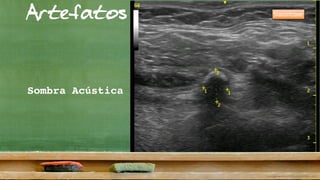 Artefatos
Sombra Acústica
Sialolitíase
 