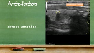 Artefatos
Sombra Acústica
calcificação Tireóide
 