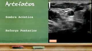 Artefatos
Sombra Acústica
carótida
Reforço Posterior
 