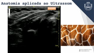 Anatomia aplicada ao Ultrassom
tireoidite
 