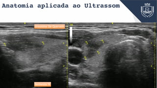 Anatomia aplicada ao Ultrassom
tireoidite De Quervein
Bethesda IV
 