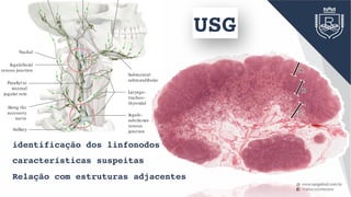 ThoracicRight
Jugulo-
subclavian
venous
junction
Laryngo-
tracheo-
thyroidal
Submental-
submandibular
Nuchal
Jugulofacial
venous junction
Parallel to
internal
jugular vein
Along the
accessory
nerve
Axillary
C Directions of lymphatic drainage in the neck
Right lateral view. The principal pattern of lymphatic ow in the neck
is depicted. Understanding this pattern is critical to identifying the lo-
cation of a potential cause of enlarged cervical lymph nodes. There are
two main sites in the neck where the lymphatic pathways intersect:
• The jugulofacial venous junction: Lymphatics from the head pass
obliquely downward to this site, where the lymph is redirected verti-
cally downward in the neck.
• The jugulosubclavian venous junction: The main lymphatic trunk, the
thoracic duct, terminates at this central location, where lymph col-
lected from the left side of the head and neck region is combined
with lymph draining from the rest of the body.
If only peripheral nodal groups are a ected, this suggests a localized
disease process. If the central groups (e.g., those at the venous junc-
tions) are a ected, this usually signi es an extensive disease process.
Central lymph nodes can be obtained for diagnostic evaluation by pres-
calene biopsy.
USG
identificação dos linfonodos
características suspeitas
Relação com estruturas adjacentes
 