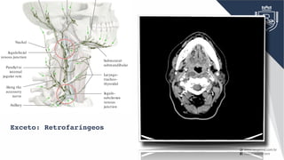ThoracicRight
Jugulo-
subclavian
venous
junction
Laryngo-
tracheo-
thyroidal
Submental-
submandibular
Nuchal
Jugulofacial
venous junction
Parallel to
internal
jugular vein
Along the
accessory
nerve
Axillary
C Directions of lymphatic drainage in the neck
Right lateral view. The principal pattern of lymphatic ow in the neck
is depicted. Understanding this pattern is critical to identifying the lo-
cation of a potential cause of enlarged cervical lymph nodes. There are
two main sites in the neck where the lymphatic pathways intersect:
• The jugulofacial venous junction: Lymphatics from the head pass
obliquely downward to this site, where the lymph is redirected verti-
cally downward in the neck.
• The jugulosubclavian venous junction: The main lymphatic trunk, the
thoracic duct, terminates at this central location, where lymph col-
lected from the left side of the head and neck region is combined
with lymph draining from the rest of the body.
If only peripheral nodal groups are a ected, this suggests a localized
disease process. If the central groups (e.g., those at the venous junc-
tions) are a ected, this usually signi es an extensive disease process.
Central lymph nodes can be obtained for diagnostic evaluation by pres-
calene biopsy.
Exceto: Retrofaríngeos
 