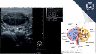 Fig. 6.2a Right side of the neck, transvers
II. An oval lymph node in acute lympha
colli (RF); the node has a delicate intern
pattern with well-defined margins and m
30mm × 15mm in both short-axis dia
A clearly visible incidental finding is the
bundle of the vagus nerve seen in cross-
between the internal (ACI) and externa
carotid arteries (asterisk). GSM, subman
gland.
*
 