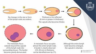 No changes in the size or form
of the lymph node are evident.
Thickness is first affected
(6 mm or greater in thickness).
The capsule also becomes thicker.
Although the entire lymph
node becomes enlarged,
the capsule is retained.
A metastatic focus occupies
almost the entire lymph node.
A border is clearly observed
(10–20 mm in thickness;
can be identified even by CT).
The metastatic focus
extends beyond the capsule
of the lymph node into
surrounding tissues. The border
becomes poorly demarcated.
1 2 3
7 6 5
4
 