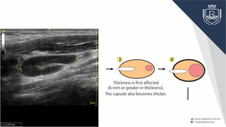No changes in the size or form
of the lymph node are evident.
Thickness is first affected
(6 mm or greater in thickness).
The capsule also becomes thicker.
1 2 3
7 6 5
4
 
