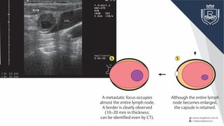 Fig. 6.23 Left side of the neck, longitudinal,
level III. A round lymph node metastasis with
irregular borders has an anechoic center, which
is indicative of necrosis caused by the metastatic
transformation. VJI, internal jugular vein; MSCM,
sternocleidomastoid muscle.
Fig. 6.24 Left side of the neck, level II. Medial to
the internal and external carotid arteries, the round
metastasis has an anechoic center consistent with
central necrosis; this is considered to be a sign of
malignancy. To the left, medial in the image, is an
ill-defined hypoechoic primary tumor (TU) of the
left side of the oropharynx. The internal jugular
vein (VJI) is compromised and can be seen between
the anterior border of the sternocleidomastoid
muscle (MSCM) and the internal carotid artery
(ACI). The vein can be demonstrated better with
a Valsalva maneuver. ACE, external carotid artery.
No changes in the size or form
of the lymph node are evident.
Thickness is first affected
(6 mm or greater in thickness).
The capsule also becomes thicker.
Although the entire lymph
node becomes enlarged,
the capsule is retained.
A metastatic focus occupies
almost the entire lymph node.
A border is clearly observed
(10–20 mm in thickness;
can be identified even by CT).
The metastatic focus
extends beyond the capsule
of the lymph node into
surrounding tissues. The border
becomes poorly demarcated.
1 2 3
7 6 5
4
 