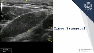 Cisto Branquial
 