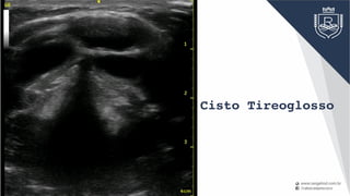 Cisto Tireoglosso
 