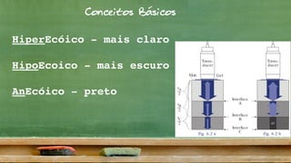 Conceitos Básicos
Trans-
ducer
Skin Gel
Trans-
ducer
Interface
A
Interface
B
Interface
C
45
t
2
A
t
2
B
t
2
C
waves that are sent by a transducer into the human body and
reflected there. In abdominal ultrasound, the frequencies
used generally are between 2.5 and 5.0 megahertz (MHz; see
p. 9).
The primary condition required for sound wave reflections is
the presence of so-called “impedance mismatches.” These
occur at the interface between two tissue layers with differ-
ent sound transmission properties (interfaces in Fig. 6.2). It is
interesting to note that different soft tissues show only minor
differences in the transmission of sound (Table 6.1). Only air
and bone are marked by massively different sound transmis-
sion in comparison with other human tissue.
For this reason ultrasound units can be operated at a prese-
lected medium frequency of approximately 1540 m/s with-
out producing any major inaccuracies in the calculated origin
(“depth”) of the echo. The processor computes the depth of
origin of the echo from the time difference detected between
emission of the sound impulse and return of the echo. Echoes
from tissue close to the transducer (A) arrive earlier (tA) than
echoes from deeper tissues (tB, tC in Fig. 6.2a). The mean
frequency is strictly theoretical since the processor cannot
know which type of tissue was traversed.
Which Component of the Sound Wave is Reflected?
Fig. 6.2a shows three tissue blocks traversed by sound waves
that differ only minimally in their transmission velocity (in-
dicated by similar gray values). Each interface only reflects a
small portion of the original sound waves (m ) as echo (i ).
Air 331 m/s
Liver 1549 m/s
Spleen 1566 m/s
Muscle 1568 m/s
Bone 3360 m/s
Sound Transmission in Human Tissue
Table 6.1
Fig. 6.2 a Fig. 6.2 b
sound waves deep to this structure from which it can gener-
ate an image. Instead, the total reflection creates an acoustic
shadow (45).
mean =1540 m/s
HiperEcóico - mais claro
HipoEcoico - mais escuro
AnEcóico - preto
 