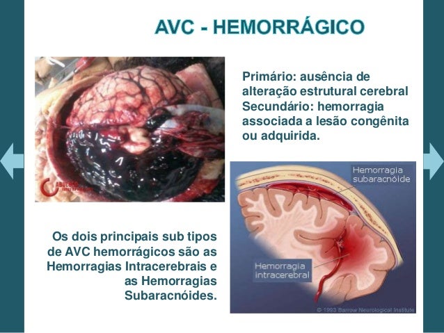 SECUELAS DE ACV HEMORRAGICO PDF DOWNLOAD SECUELAS DE ACV HEMORRAGICO PDF DOWNLOAD