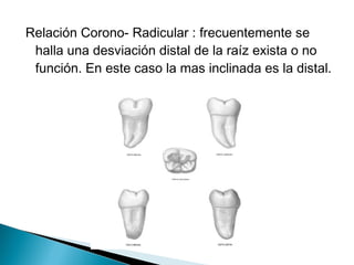 Relación Corono- Radicular : frecuentemente se
 halla una desviación distal de la raíz exista o no
 función. En este caso la mas inclinada es la distal.
 